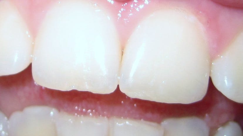 Föreläsning om tandhälsa